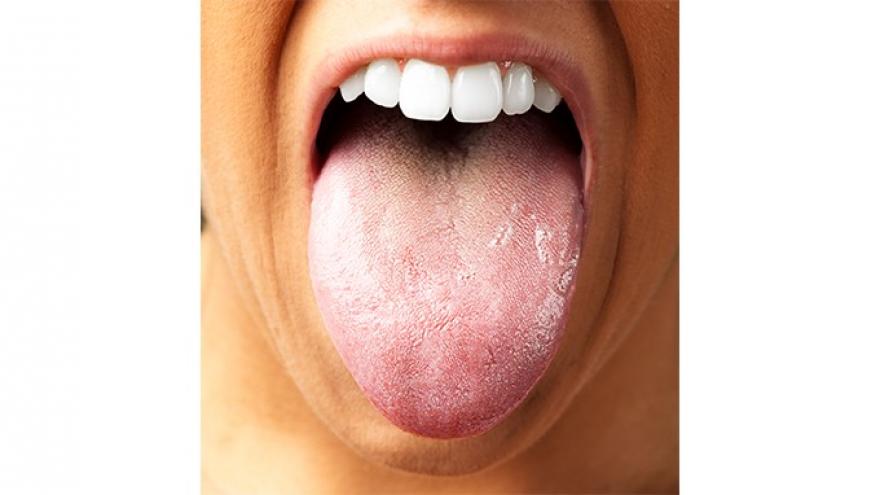 舌苔發白是怎么回事