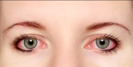 眼睛红是怎么回事