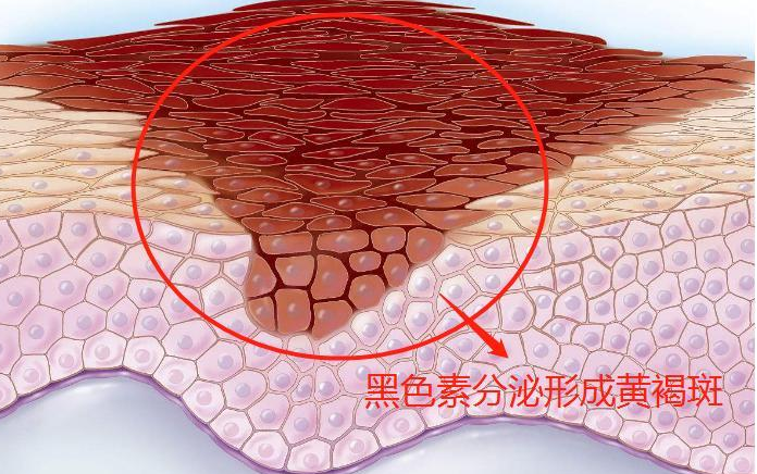 出汗能促进脸部黑色素淡化吗