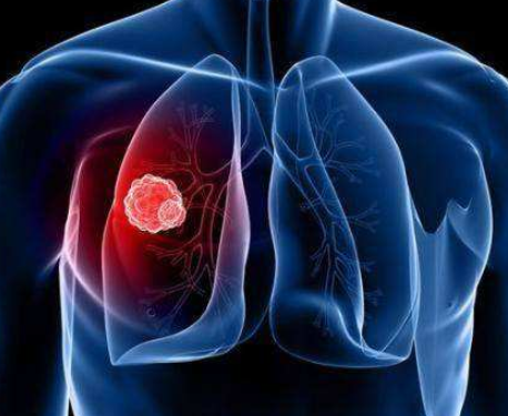 晚期肺癌的如何控制病情