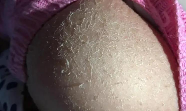 皮肤出现干燥是什么原因？