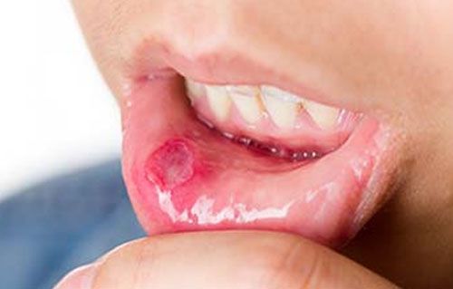 口腔溃疡反复发作怎么根治