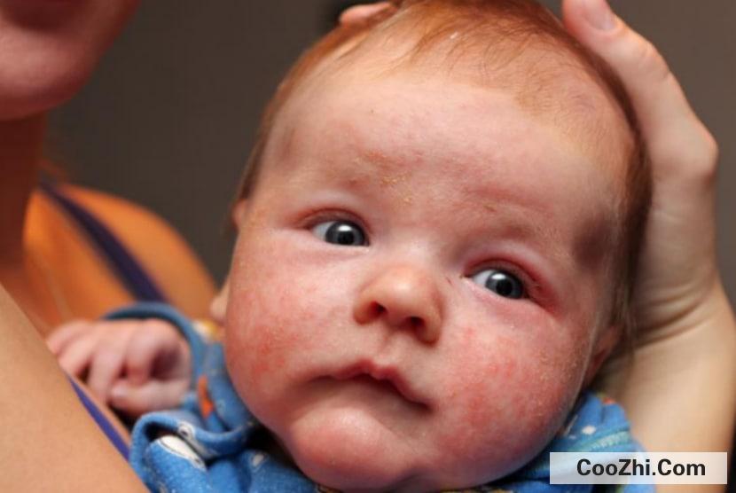 怎么护理有湿疹的宝宝
