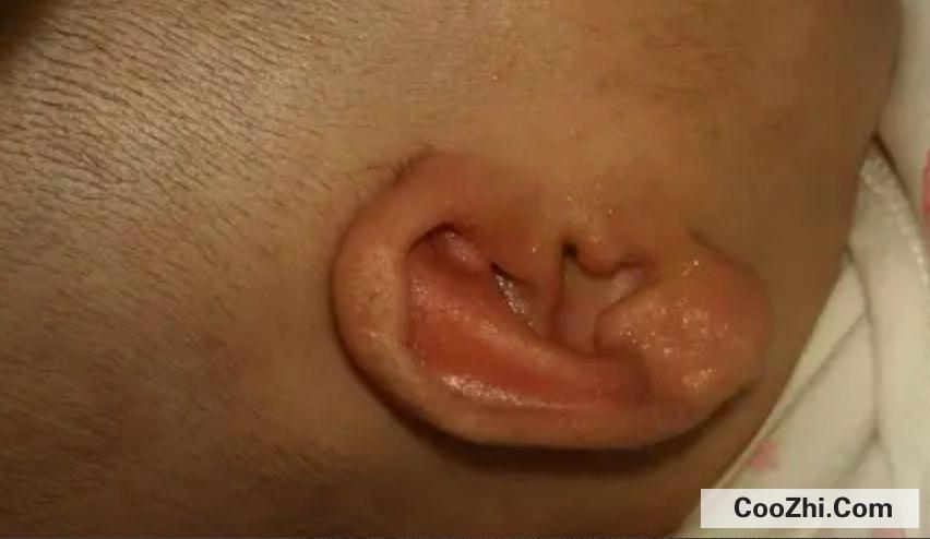 耳朵湿疹是什么原因造成的