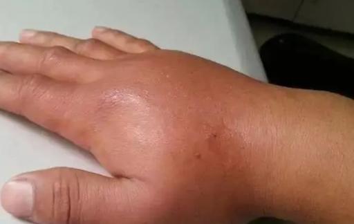 被蜜蜂蛰了如何处理