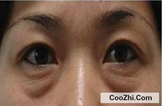 怎样消除脂肪型眼袋