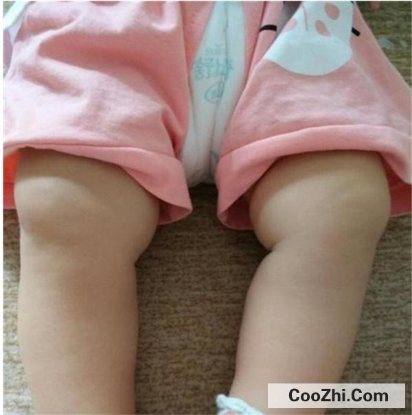 孩子长期睡觉绑腿腿能直吗