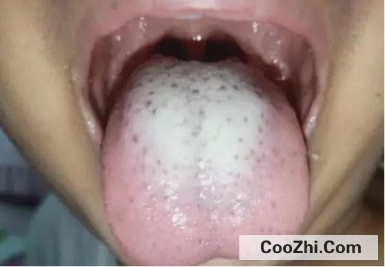 婴幼儿舌苔为什么发白