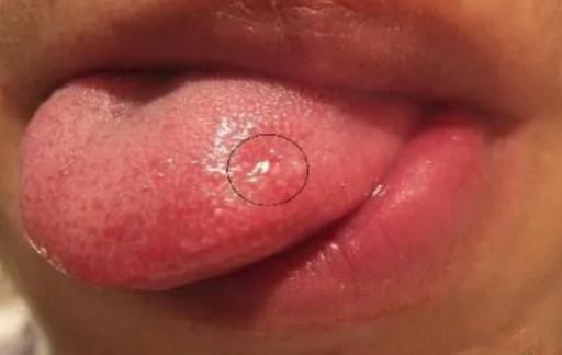 舌头出现溃疡怎么办