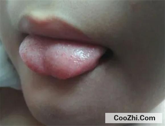 宝宝舌苔为什么会出现变化