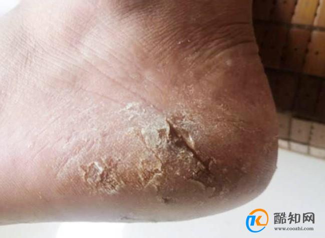 脚后跟干裂起硬皮是什么原因