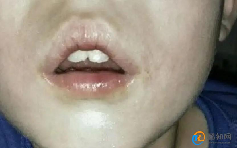 腺样体肥大是什么症状