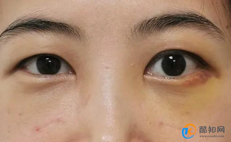 去眼袋最快最好方法是什么