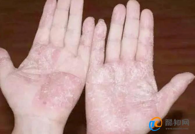 手脱皮是什么原因导致的