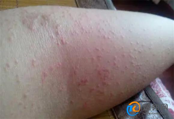 湿疹是什么原因造成的