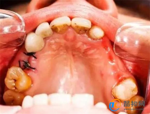 拔牙第3天为什么又疼的厉害了