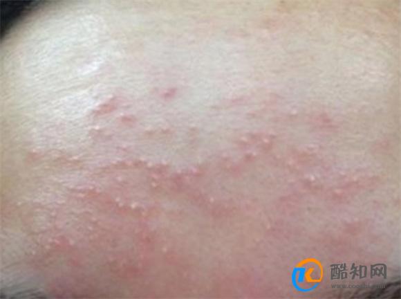 湿疹是什么原因造成的