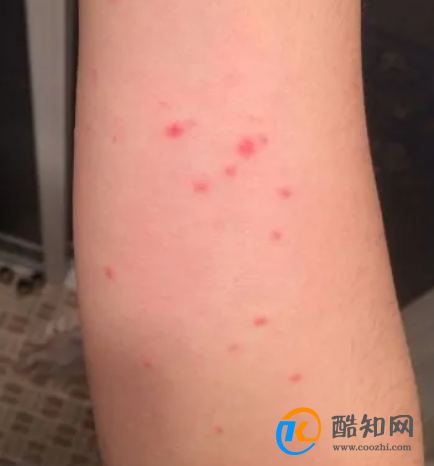身上长红点是什么原因呢?干万不要掉以轻心