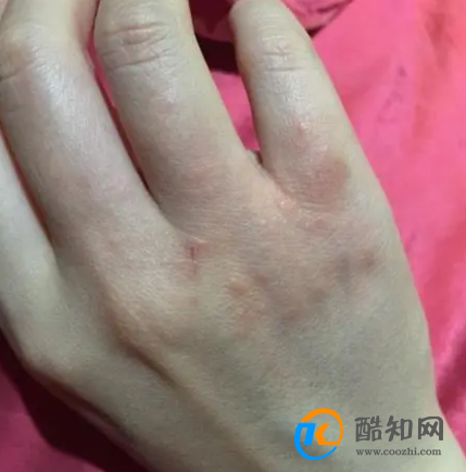 身上长红点是什么原因呢?干万不要掉以轻心