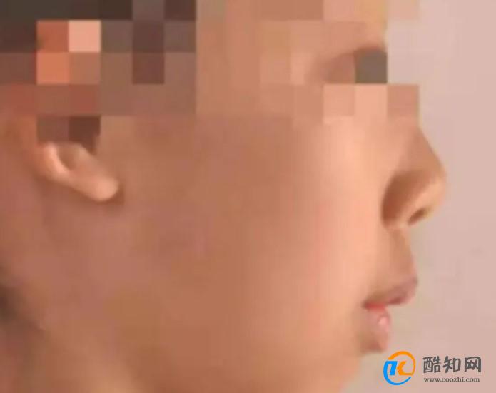 用嘴呼吸会导致腺样体面容吗