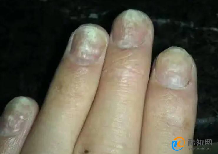 指甲有竖纹是什么病的前兆