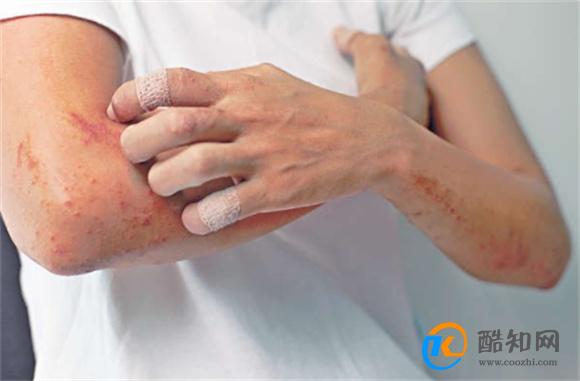 皮肤病症状有哪些皮肤病应该如何治疗