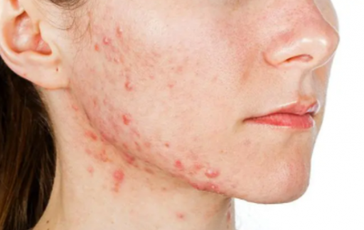 皮肤病症状有哪些皮肤病应该如何治疗