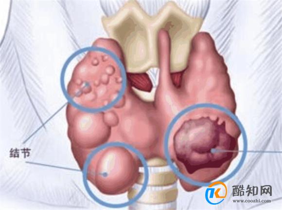 甲状腺结节是什么病