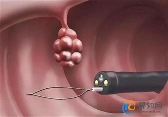 肠道里长了息肉 上厕所时或早有信号 不要等到中晚期才发现