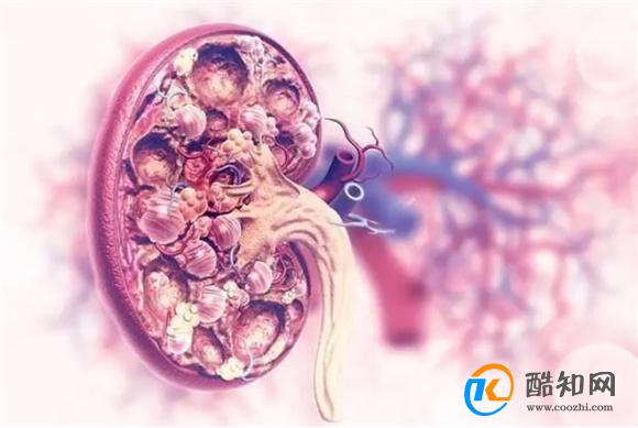 什么是“肾囊肿”？内科医生：7个饮食禁忌，别不当回事