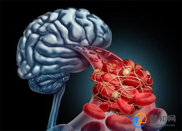 脑血管堵塞有“前兆” 这4个“红色信号” 希望家人早些发现