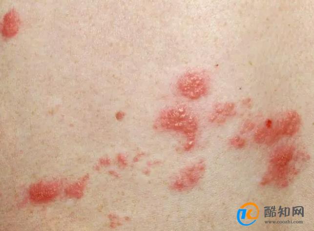 带状疱疹又叫“缠腰蛇”，该怎么治？医生：这10类人易被盯上！