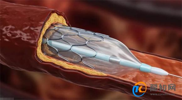 国内将逐渐停止心脏支架的手术心脏支架手术好还是不好
