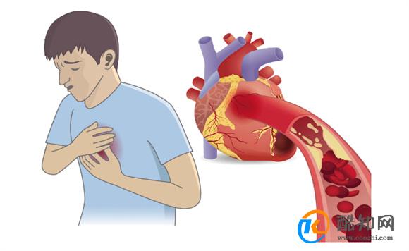 心梗发作前征兆以及自救方法 症状初期表现是什么