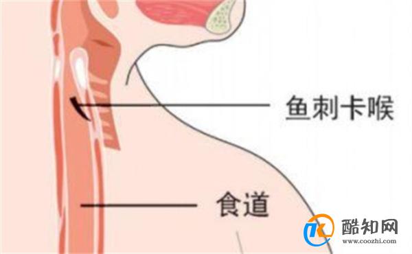 鱼刺卡喉咙的紧急处理方法 鱼刺卡在喉咙能自愈吗