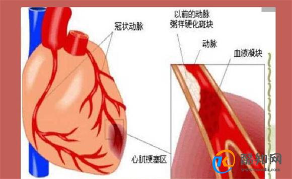 心梗发作前征兆以及自救方法 症状初期表现是什么