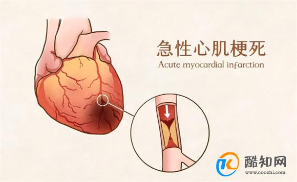 心梗发作前征兆以及自救方法 症状初期表现是什么