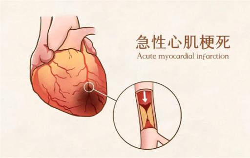 心梗发作前征兆以及自救方法 症状初期表现是什么