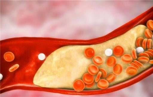 “坏胆固醇”并非越低越好 过低也可能危害身体健康