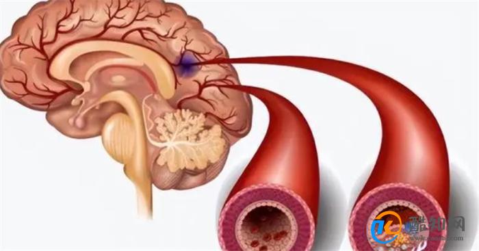 什么是腔隙性脑梗塞  脑梗的预防和治疗方法有哪些 