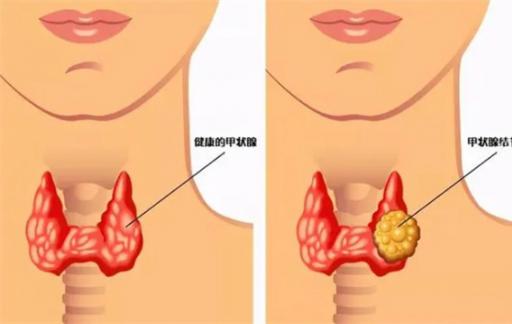 甲状腺结节，不能碰“海带”吗？医生：牢记“5吃5不吃”，护甲功