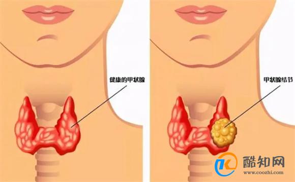 甲状腺结节，不能碰“海带”吗？医生：牢记“5吃5不吃”，护甲功