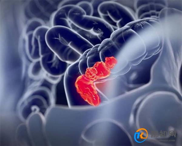 肠癌早期有什么症状  提醒  当身体露出5个信号时 建议做个肠镜