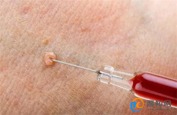 脖子、腋下长的小肉粒是什么？揪掉会怎样？一文说清楚