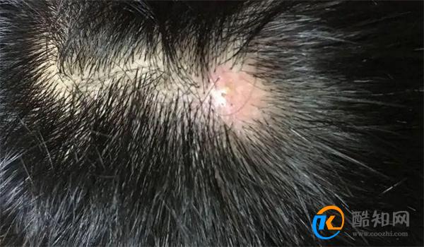 头皮里老是长疙瘩和脓包  是咋回事  提醒：或是疾病信号