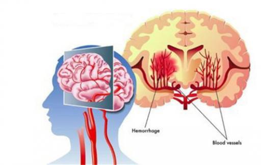 家人突发脑出血咋办  医生教你3个家庭急救办法  关键时候能救命