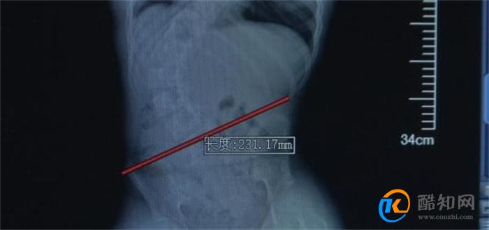 3周时间接诊5名下腰瘫痪孩子 什么原因导致腰瘫 如何治疗