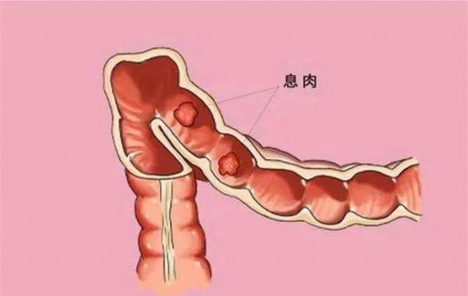 肠道里长息肉 上厕所有5个提示 别等到晚期了才反应过来