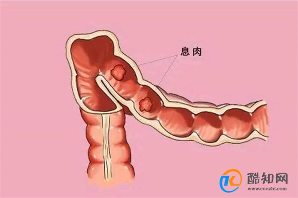 肠道里长息肉 上厕所有5个提示 别等到晚期了才反应过来