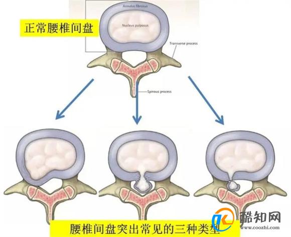 睡觉时老是腿抽筋，就是缺钙？错！还要留心这几种疾病，别忽略